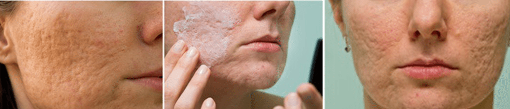 Acne scars treatment - Clear Medical 