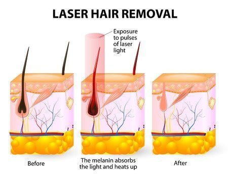 IPL Laser Hair Removal image before and after treatment - Clear Medical