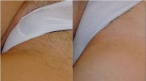 before and after bikini laser hair removal - Clear Medical