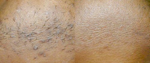 Before and after ingrown hairs laser treatment - Clear Medical