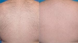 before and after laser hair removal on back - Clear Medical 