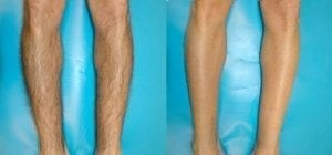 Before and after laser hair removal on legs - Clear Medical