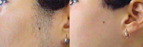 Laser Hair Removal Before And After | Manchester | Clear Medical Laser Hair Removal Before And After | Manchester | Clear Medical