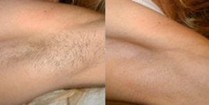 before and after underarm laser hair removal