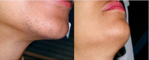 Before and after laser hair removal on chin