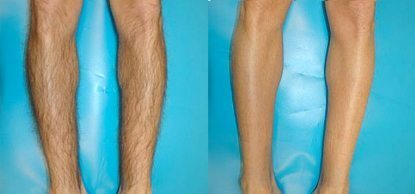 Before and after laser hair removal on legs - Clear Medical 