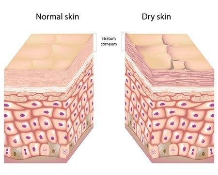 dry skin cream is used due to the stratum corneum being crusted