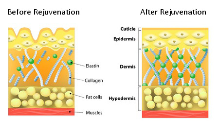 The effects of Skin Rejuvenation on skin before treatment and after Diagram showing the effects of Skin rejuvenation on skin before and after Clear Medical