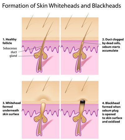 Formation of a whitehead and blachead