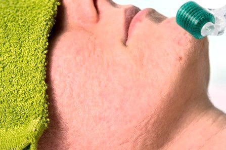 Microneedling Acne Scars - Acne Scarring Treatment