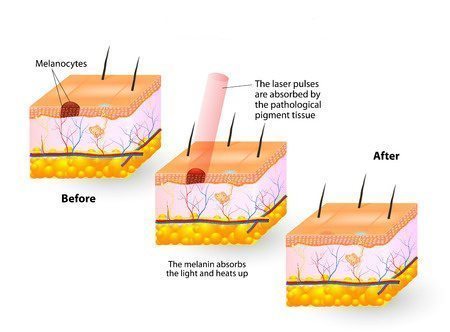 pigment and skin laser diagram