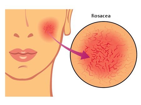 Image of rosacea on cheek of a woman