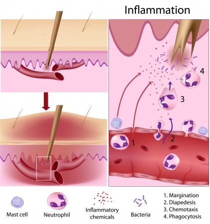 Skin infections treatment at Clear Medical - diagram of inflammation