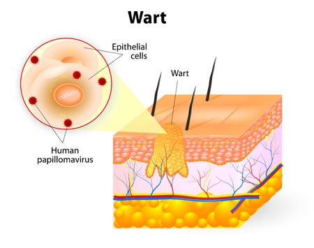 Clear Medical - Diagram of wart on skin - WARTS