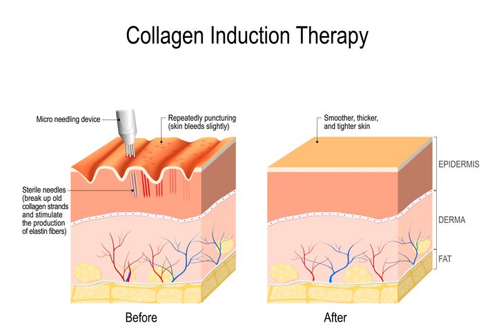 Electropration microneedling collagen induction