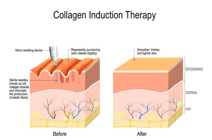 Electropration microneedling collagen induction