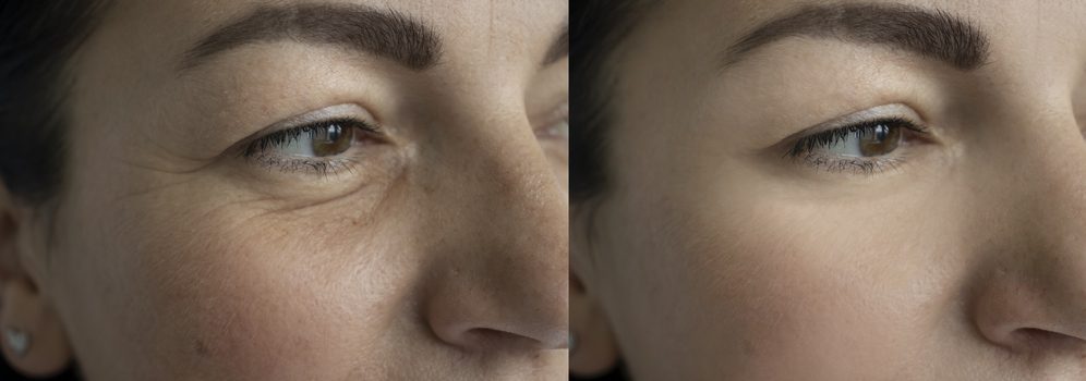 Electroporation microneedling, before and after eye area treatment.