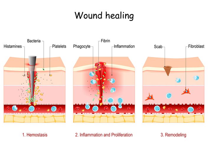 Electroporation microneedling wound healing
